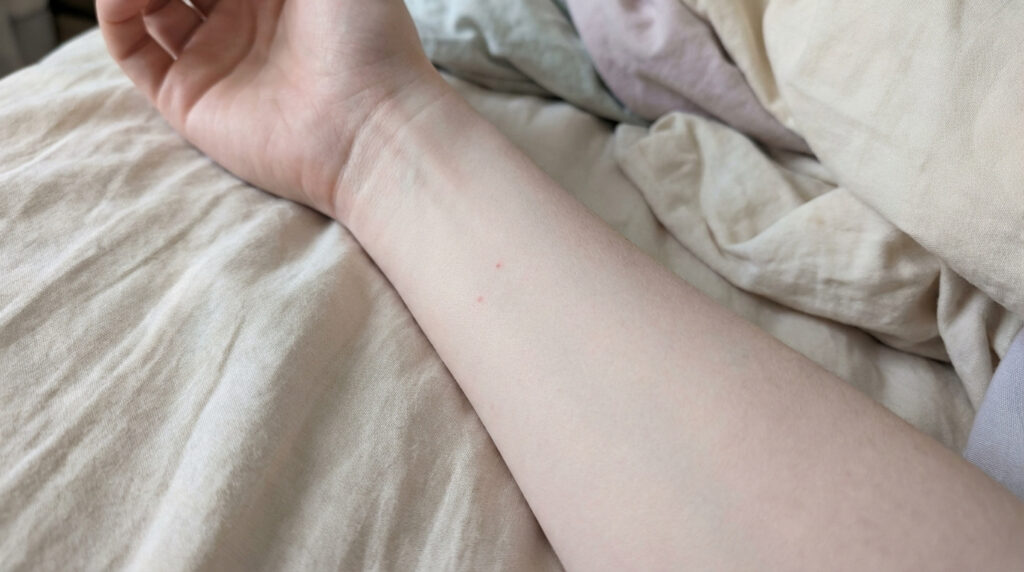 Gros plan sur un avant-bras pâle posé sur des draps de lit clairs, révélant deux petites piqures rouges distinctes.